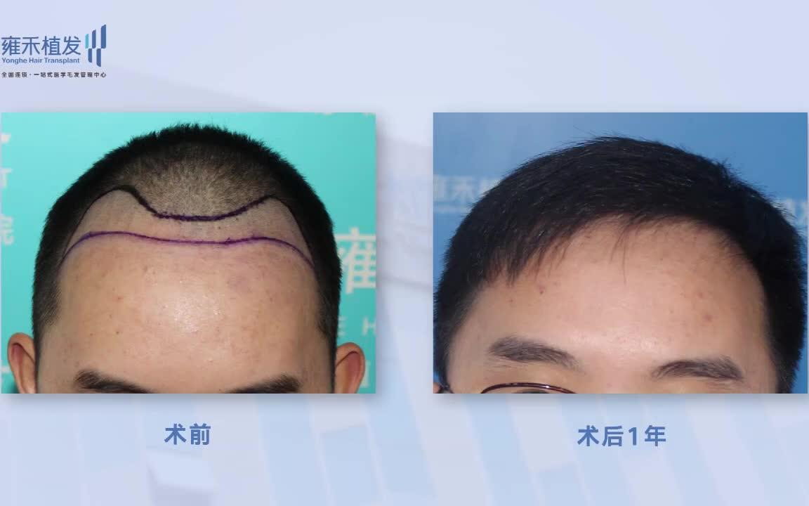 [图]深圳fue植髮頭頂加密術後效果分享 2880單位Yonghe hair transplant