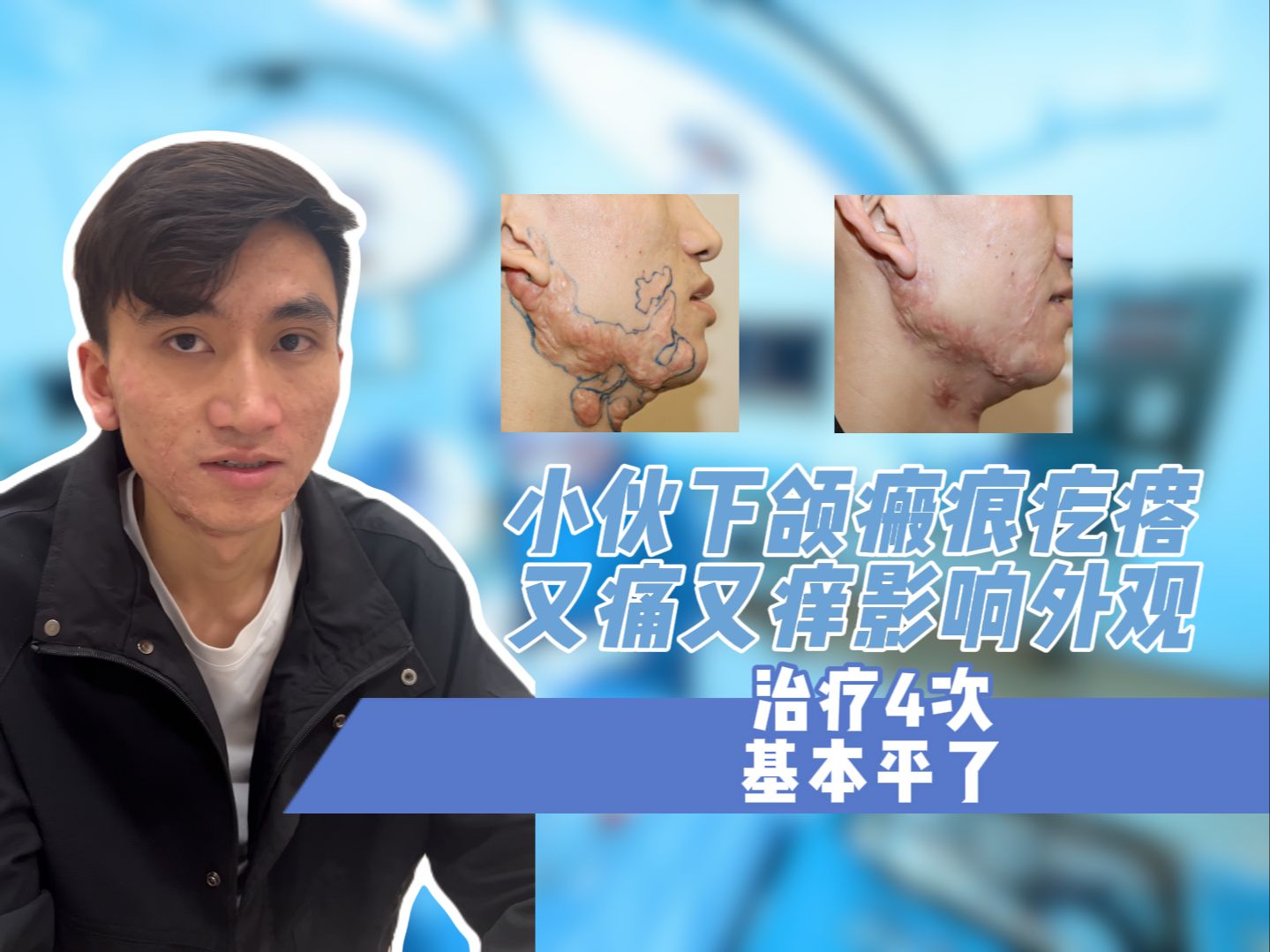 小伙下颌瘢痕疙瘩 又痛又痒影响外观