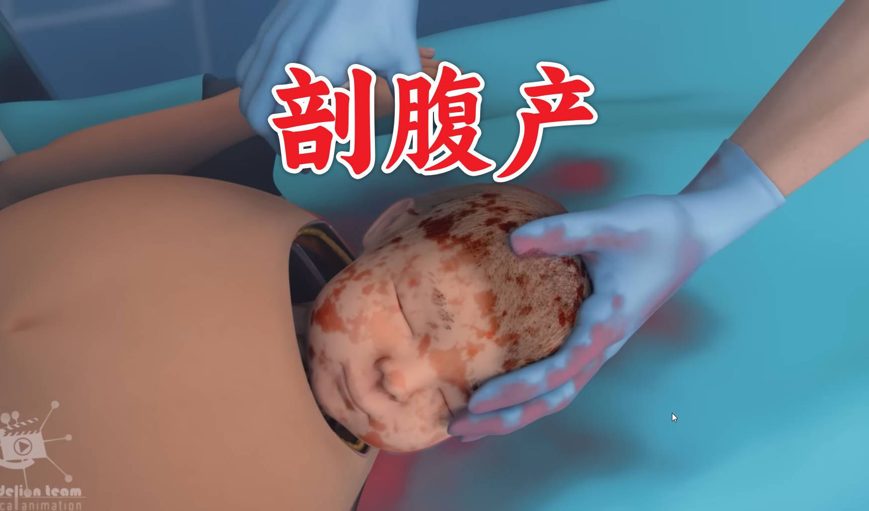 动画详解剖腹产【医学科普】哔哩哔哩bilibili