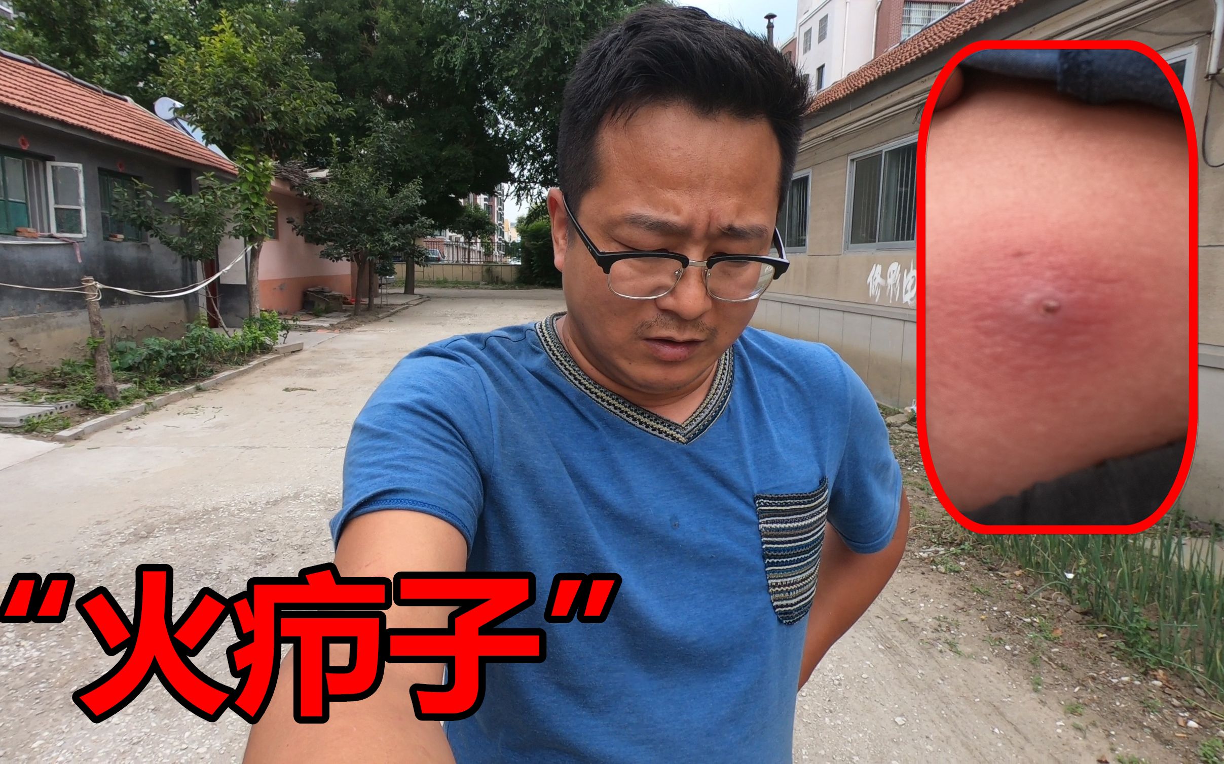 农村维修师傅上火长火疖子,晚上都睡不着觉,你说到底该怎么办?