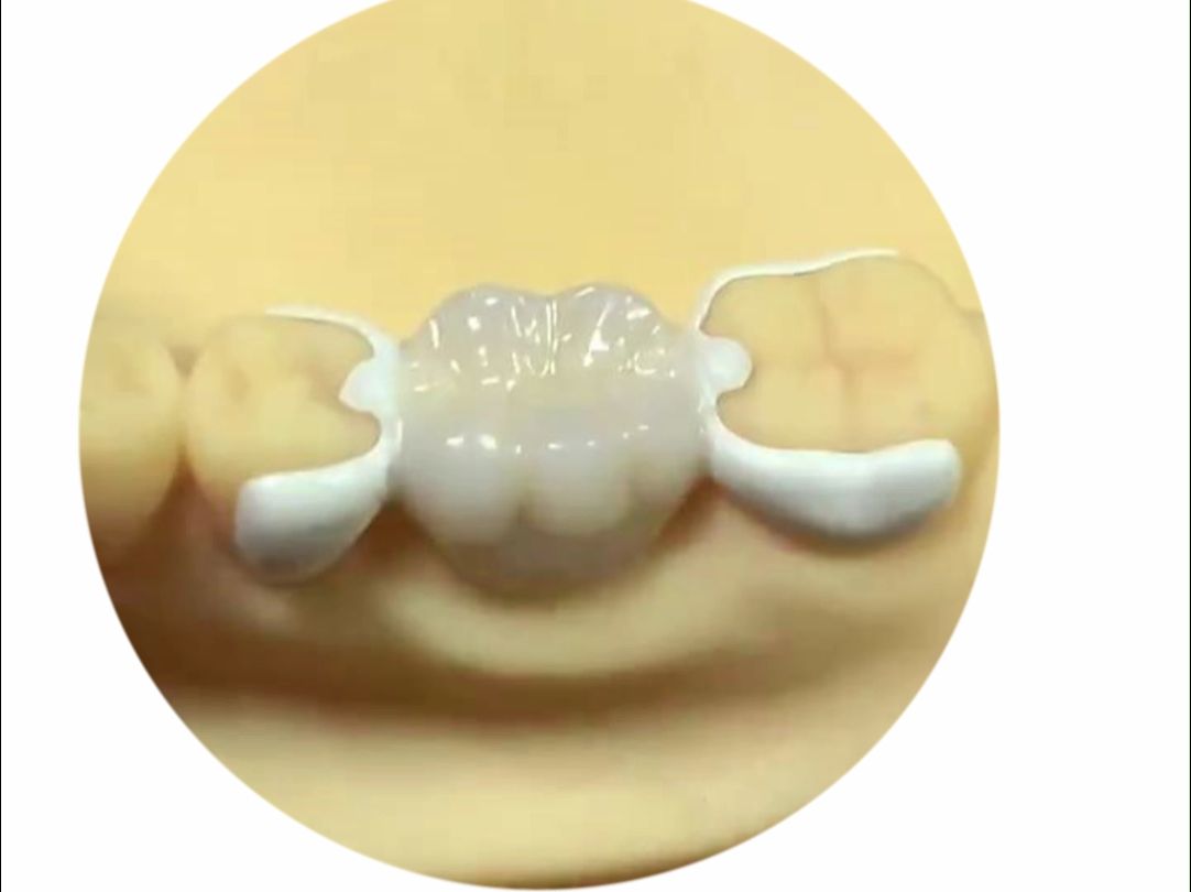 牙齿缺失,马里兰桥不磨牙修复!