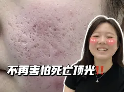 Download Video: 痘坑治愈！女大学生2年治痘坑消失全历程，秒变自信美女！