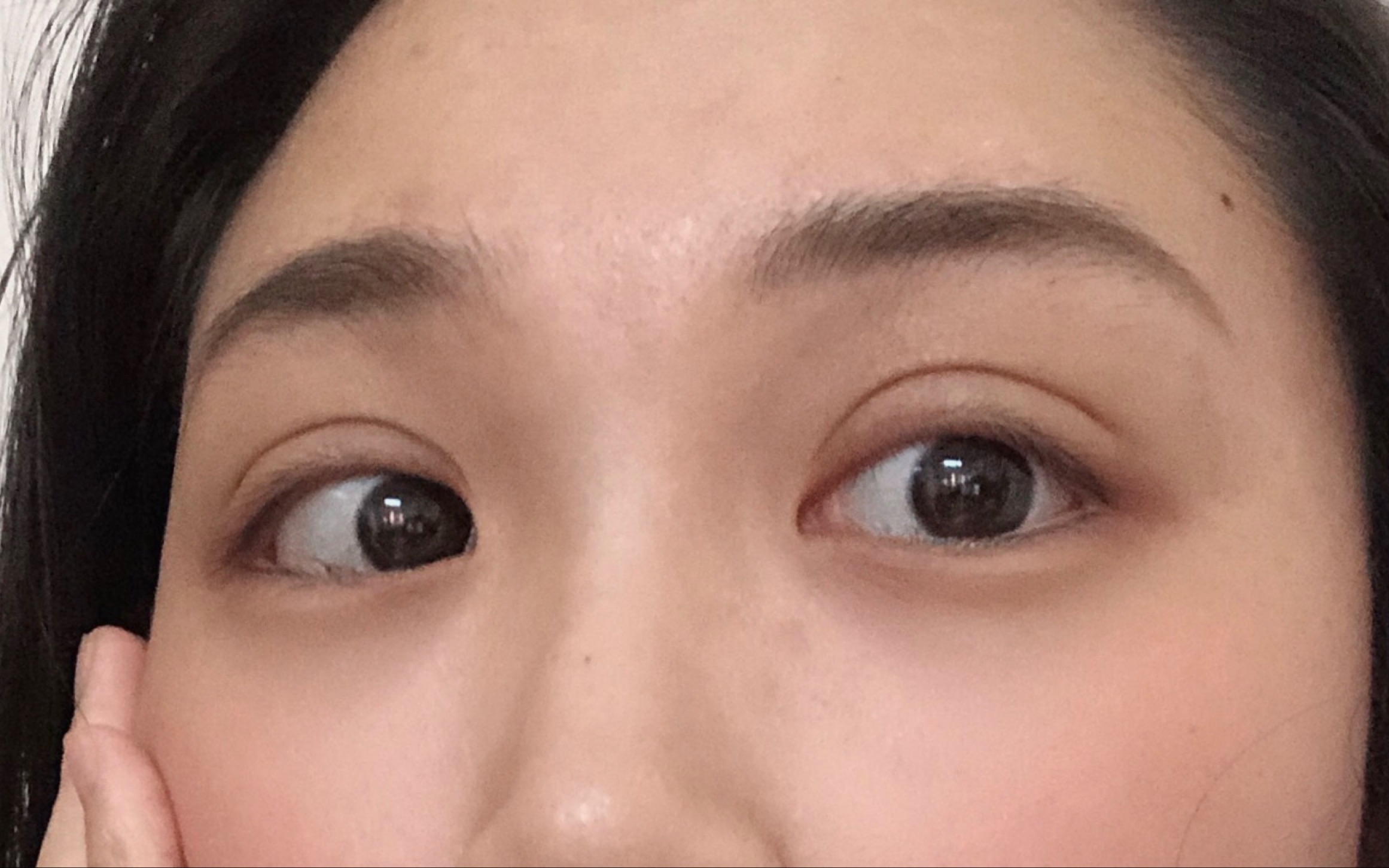 无痕双眼皮术后的第十二天恢复情况