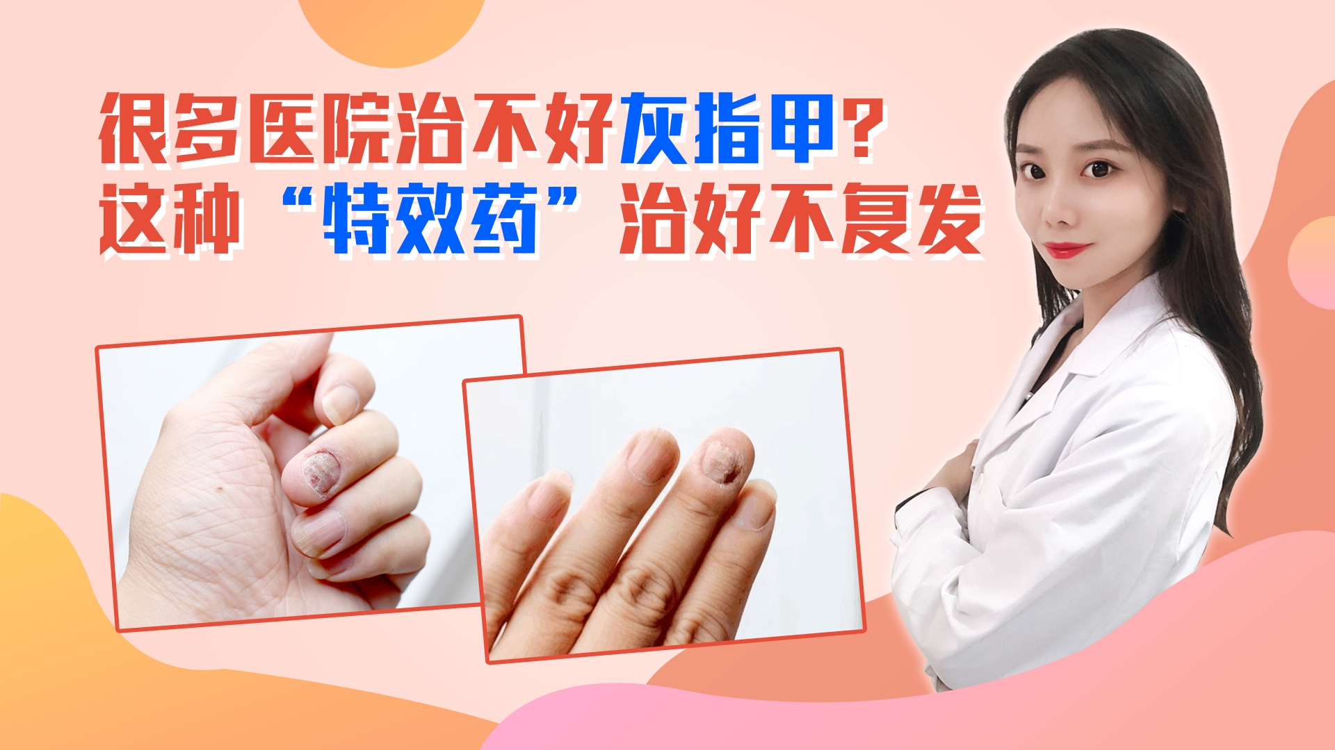 很多医院治不好灰指甲?其实很容易治,这种“特效药”治好不复发哔哩哔哩bilibili