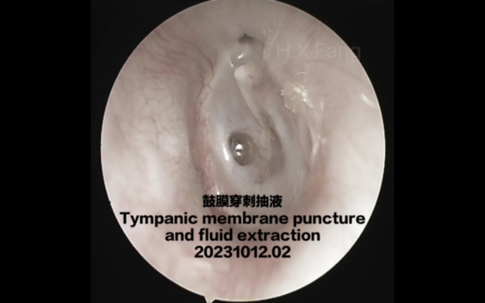 (去色版)鼓膜穿刺抽液Tympanic membrane puncture and fluid extraction20231012.02哔哩哔哩bilibili