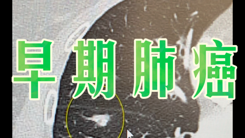 早期肺癌 没有任何症状 多查体发现