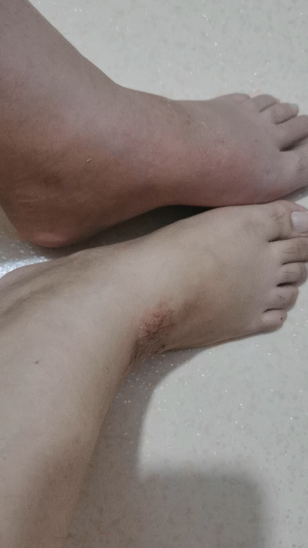 都怪我禁不住诱惑跟出去吃饭,这下最惨的骨折人实锤了,两个脚腕都摔肿