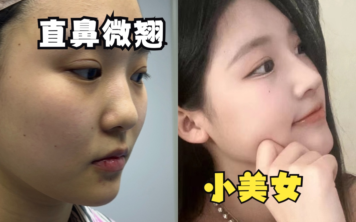 直鼻微翘 鼻综合 隆鼻