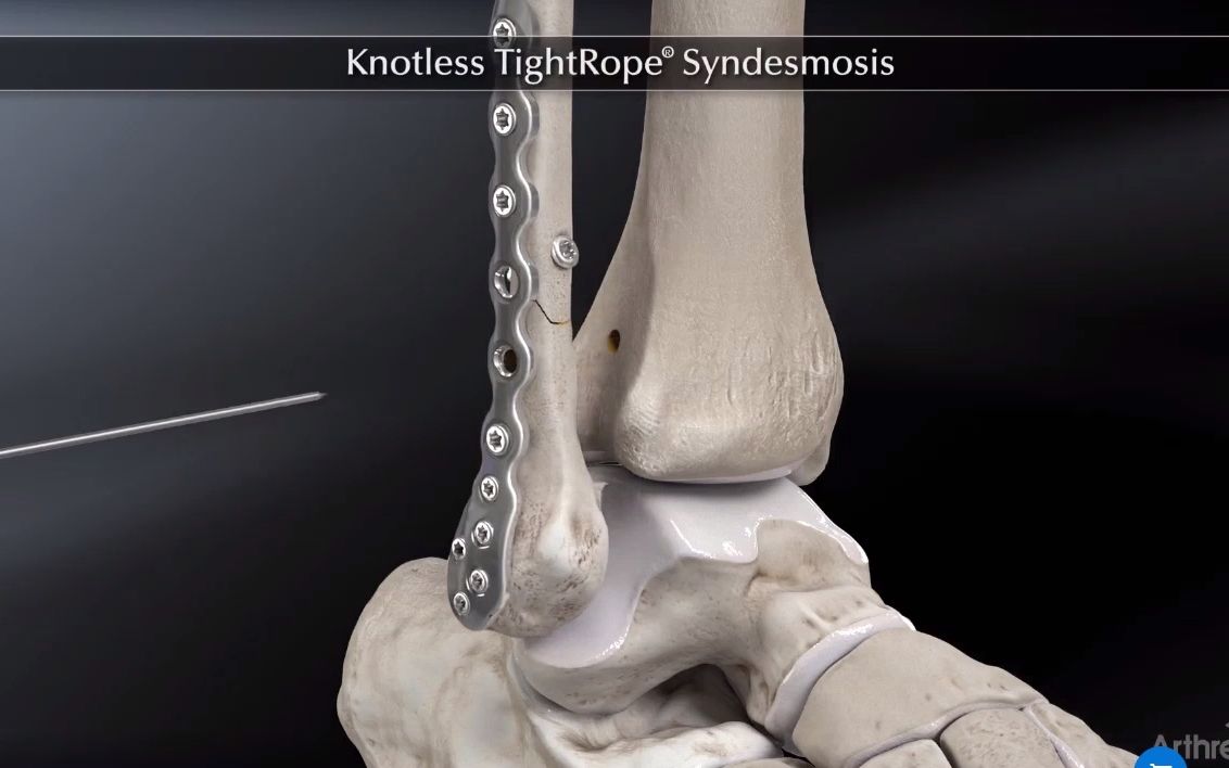 [图]Knotless TightRope® Syndesmosis