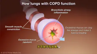 Download Video: 了解慢阻肺（COPD）