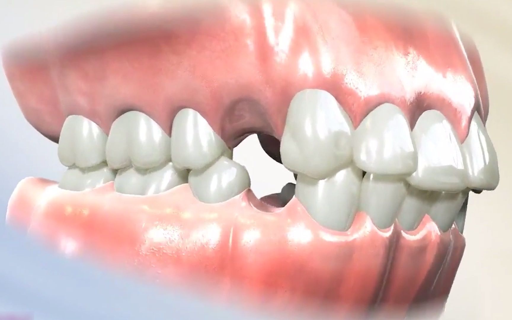 牙齿正畸:为什么正畸拔牙拔第一前磨牙