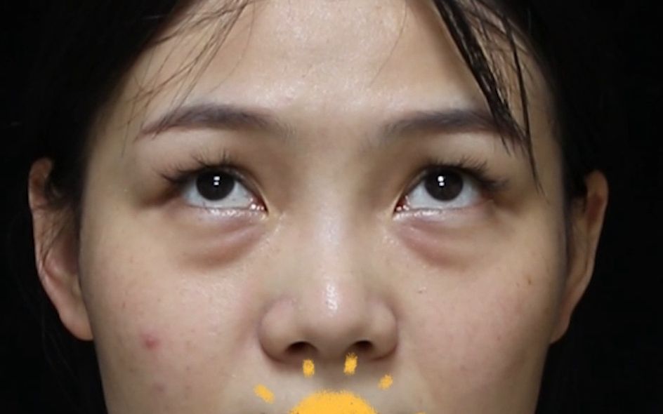 眼袋泪沟深,脂肪胶填充一步到位!