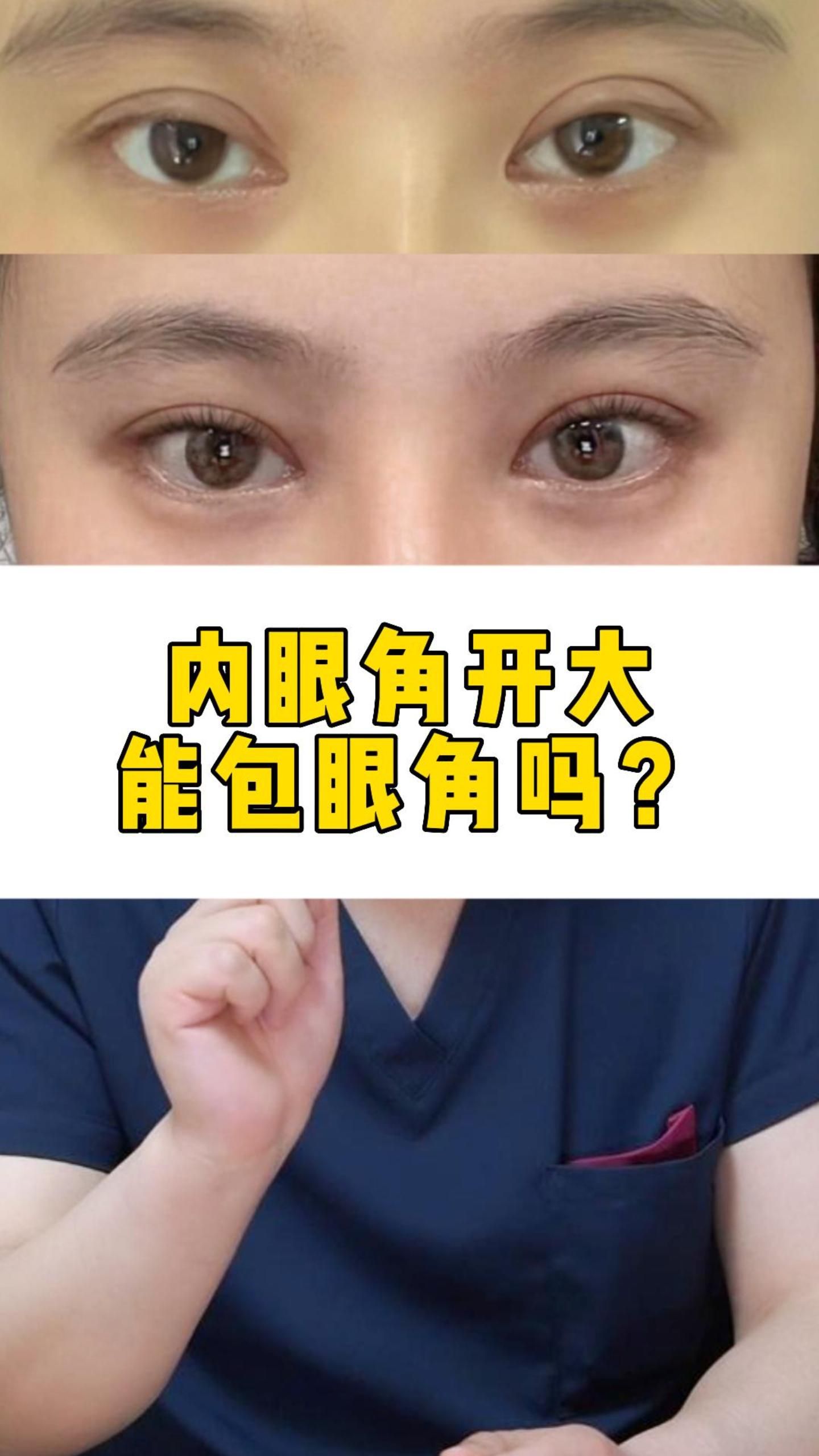 内眼角开大 能包眼角吗?