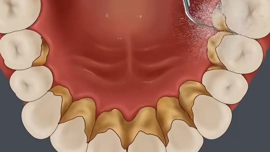 解压动画:我滴妈!这牙结石这么多!