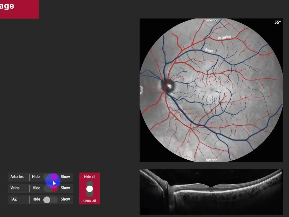 [图]OCT及眼底结构学习-互动视频