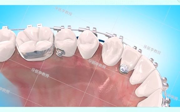 牙性地包天佩戴矫治器就可以完成矫正一起来看看吧哔哩哔哩bilibili