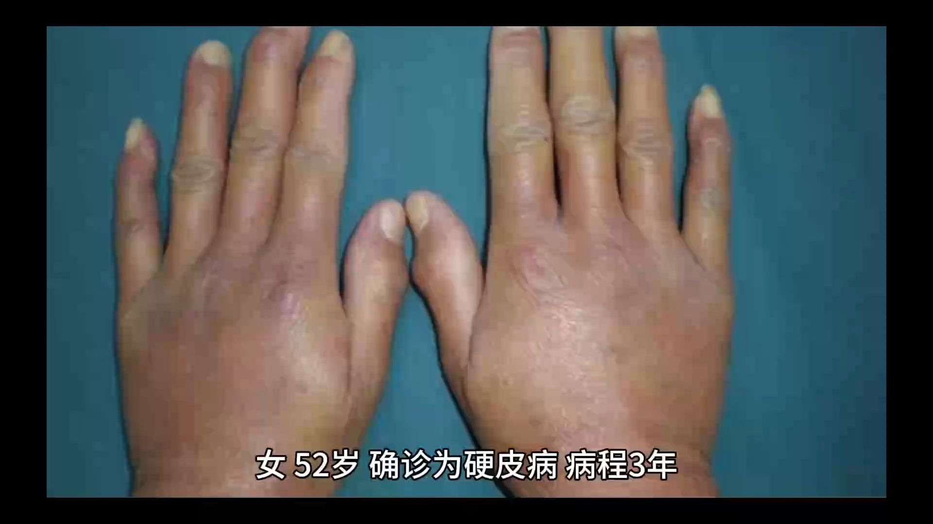 硬皮病皮肤硬化,僵硬,四肢冰凉,温阳祛痹方剂充盈气血,改善现状