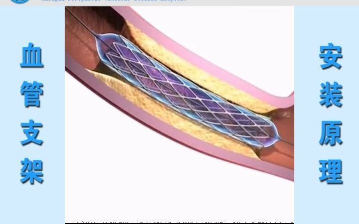 血管支架是如何工作的?哔哩哔哩bilibili
