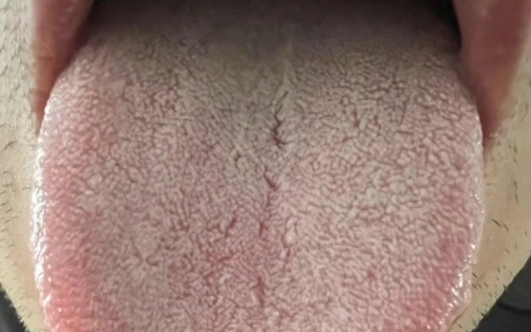 舌苔裂纹,舌色晦暗——问题主要在心脾两虚,气血生化太少了!