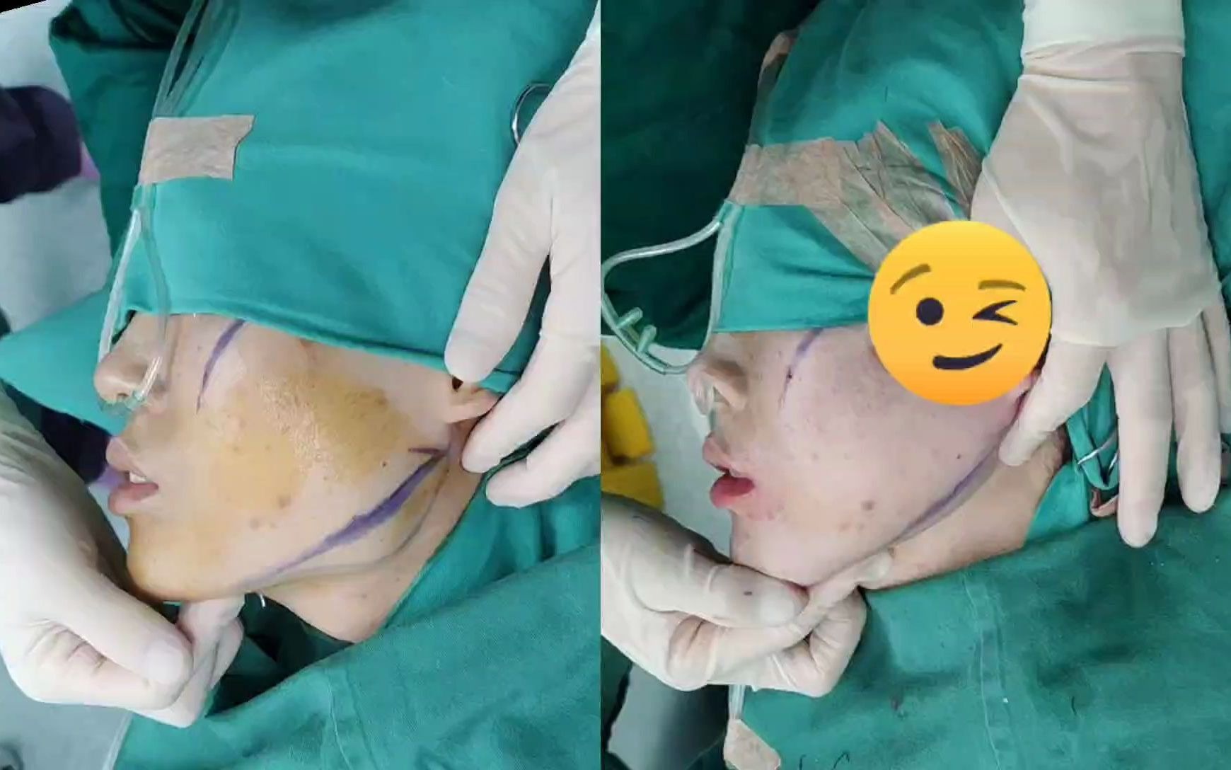 黄大勇下颌角改脸型,术后即刻