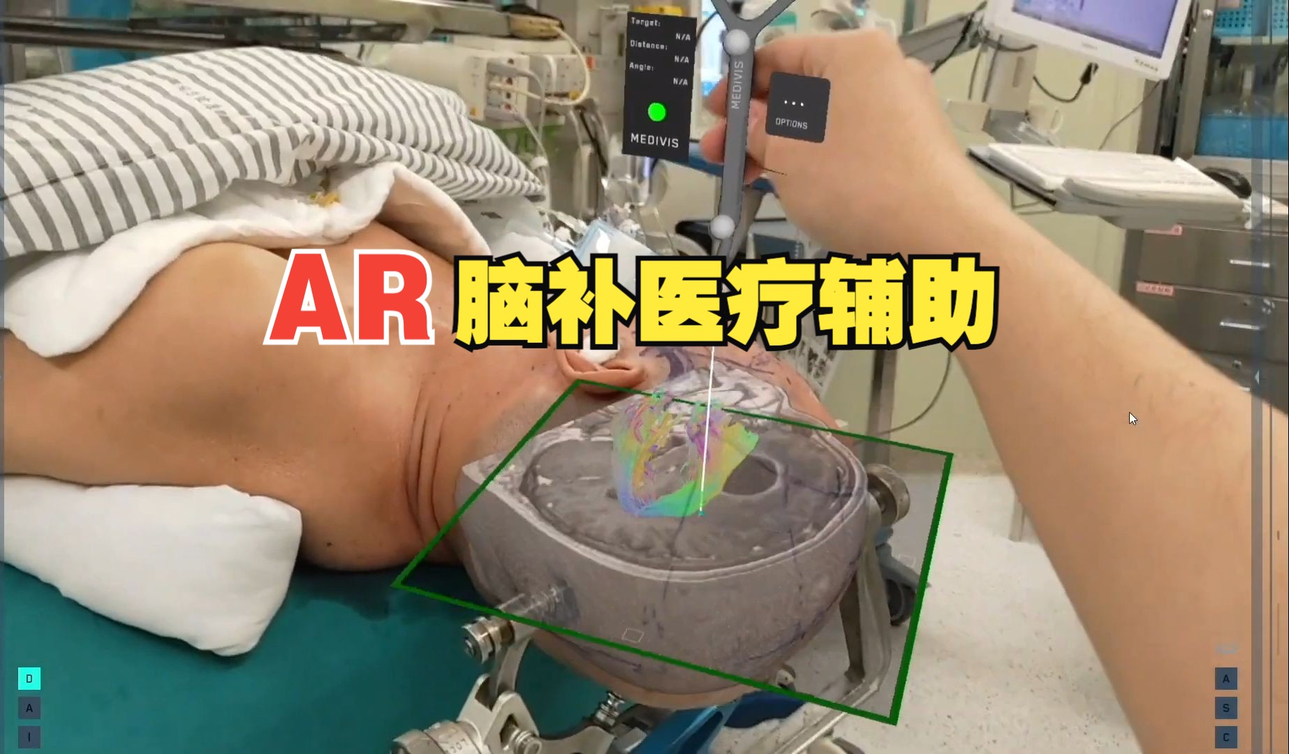 SurgicalAR将实时纤维束成像与AR结合,提高脑肿瘤切除精度哔哩哔哩bilibili