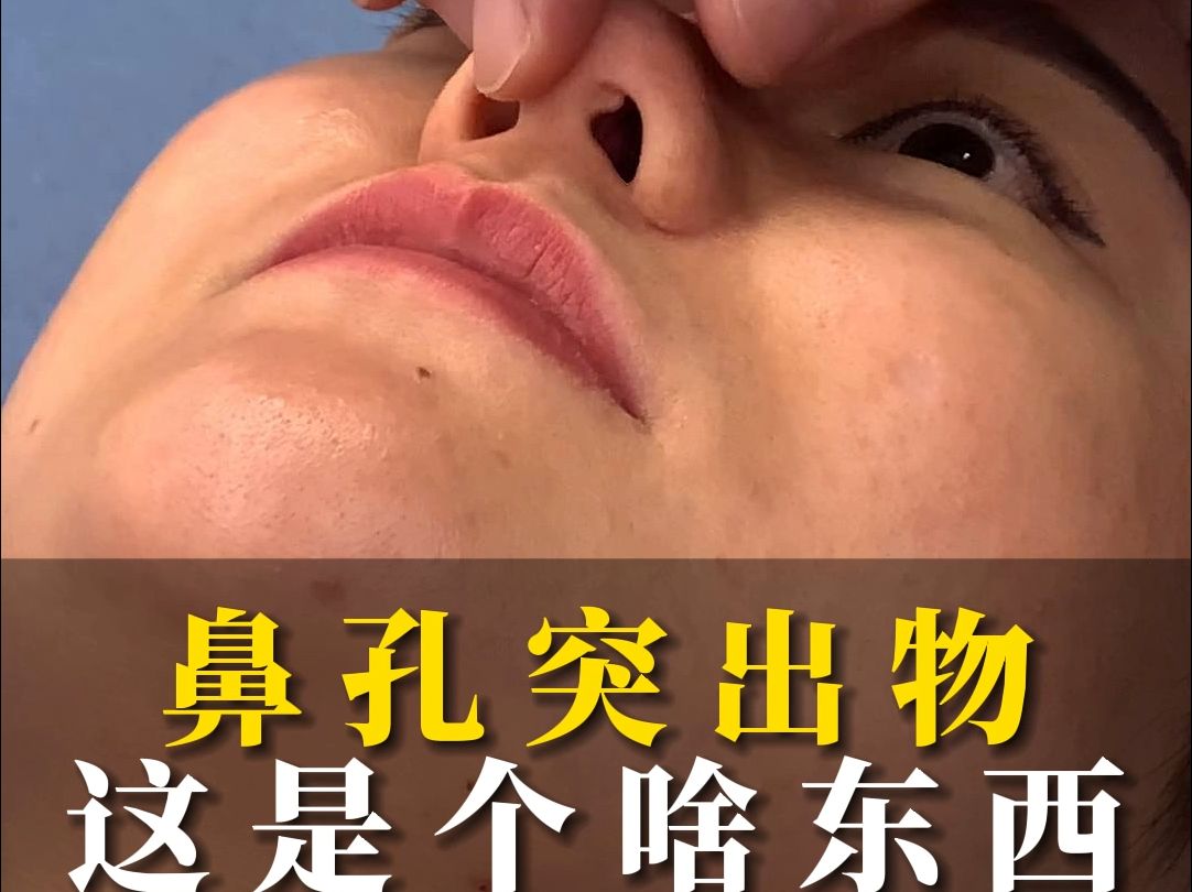 鼻孔有个小疙瘩.