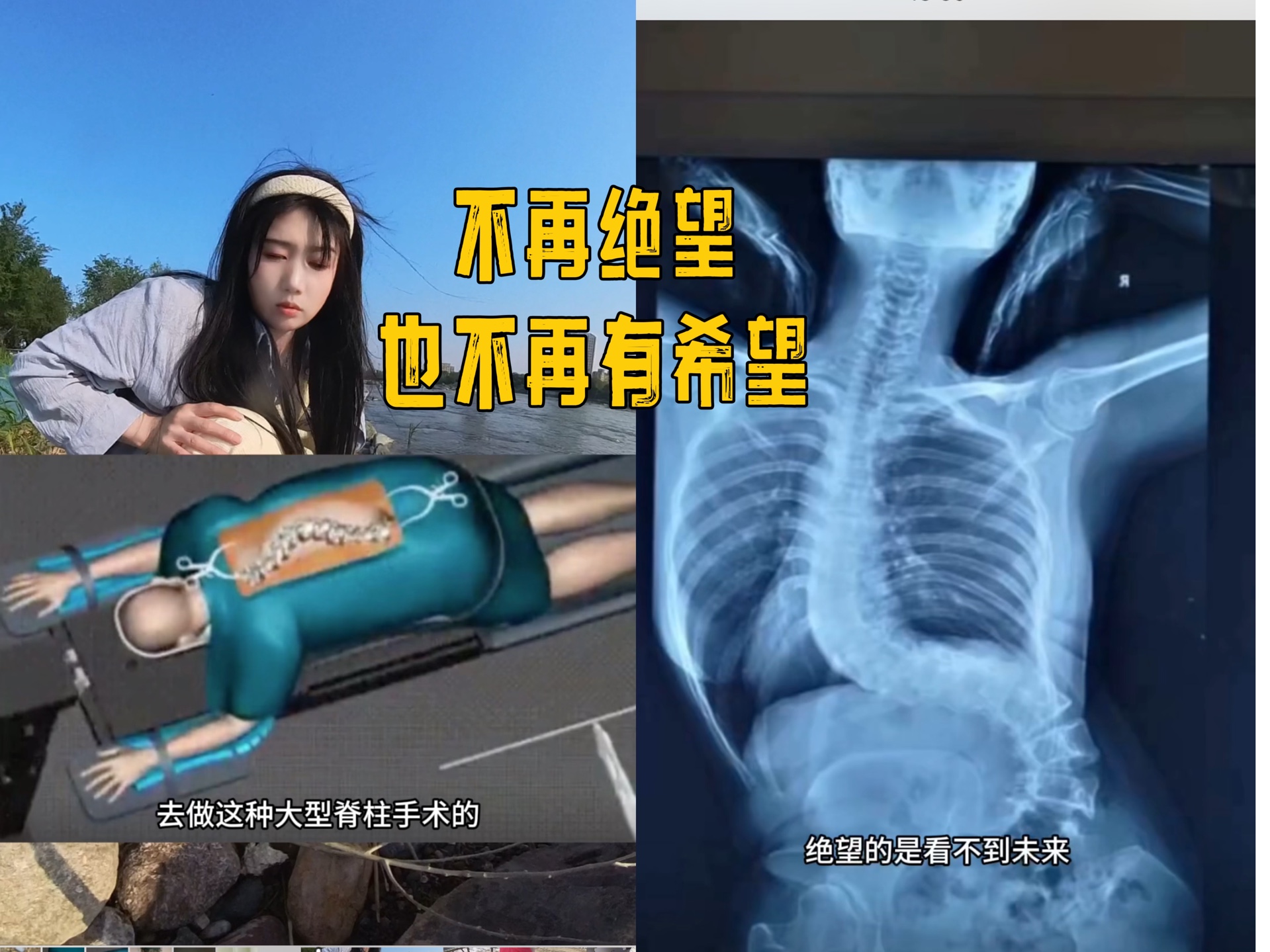 每一个跑到医院里去做这种大型脊柱侧弯手术的,不是对生活很绝望就是对未来充满了希望,因为一起的我就是这样一个人跑到医院的,而现在的我两个都没...