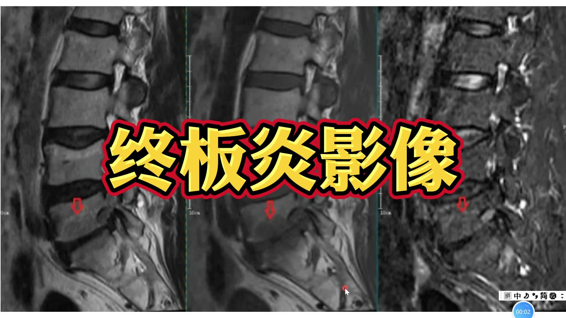 三型终板炎典型MRI表现,简单易懂!!-影像科刘医生-影像科刘医生-哔哩哔哩视频