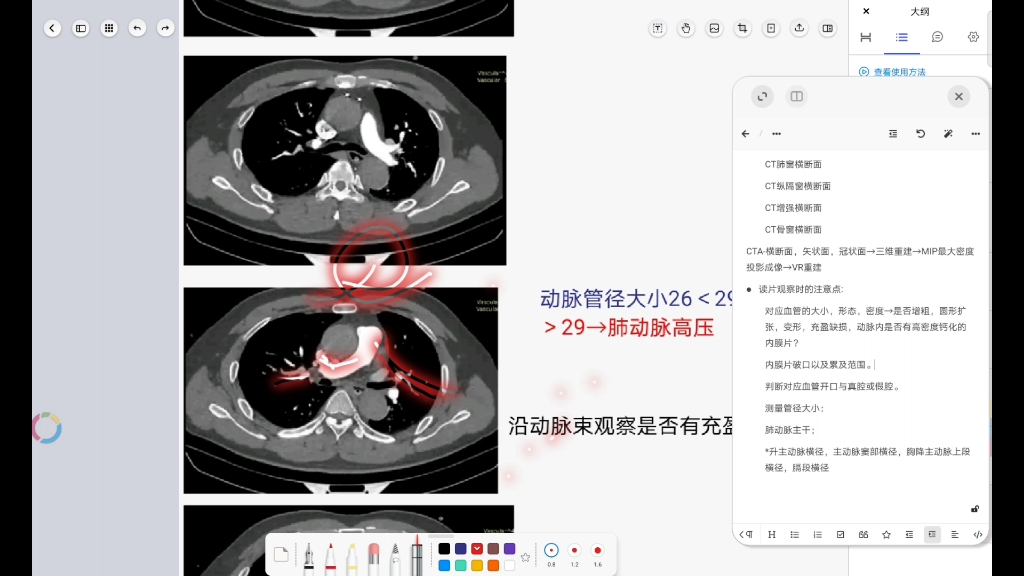 影像读片复盘 循环系统 主动脉夹层哔哩哔哩bilibili