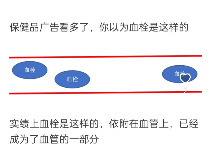 既然血管支架能穿进人的血管,为何不直接用支架把血管里的血栓吸出来?哔哩哔哩bilibili