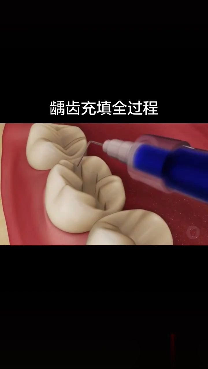 龋齿填充全过程