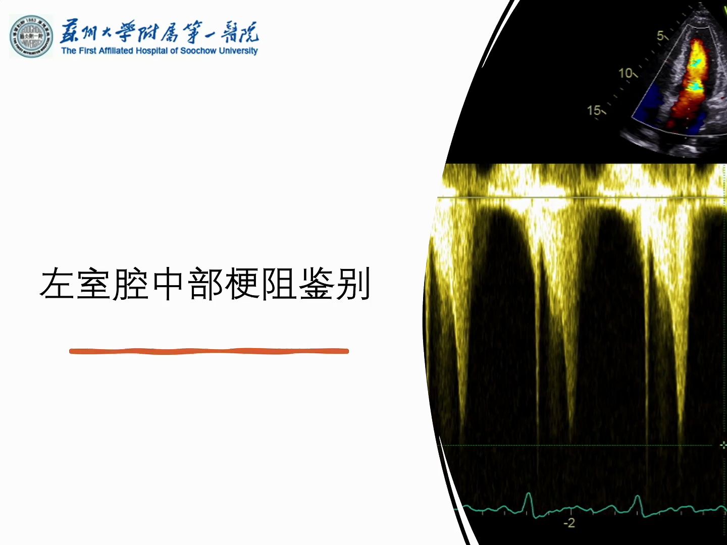 左室腔中部梗阻鉴别哔哩哔哩bilibili