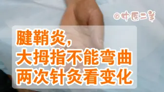 Download Video: 大拇指关节疼痛动不了，两次针灸后看结果