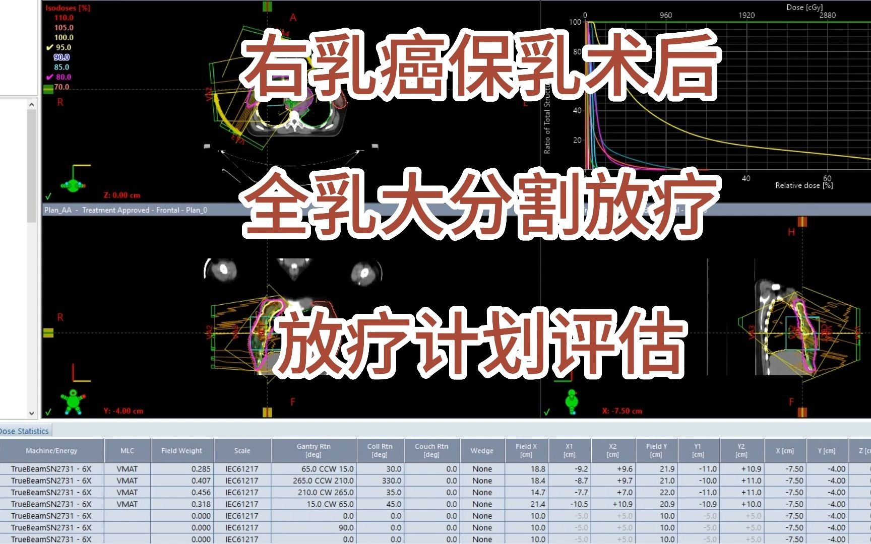 手把手教!乳腺癌保乳术后全乳大分割放疗放疗计划评估方法哔哩哔哩bilibili