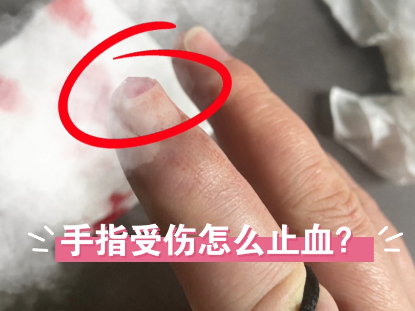 手指受伤后该怎么止血?一个视频告诉你.你有可能都做错了.