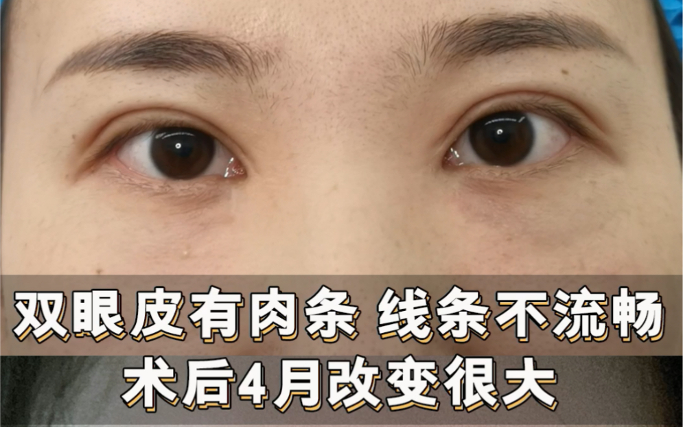 双眼皮有肉条 线条不流畅 修复4个月后改变就很大_哔哩哔哩_bilibili