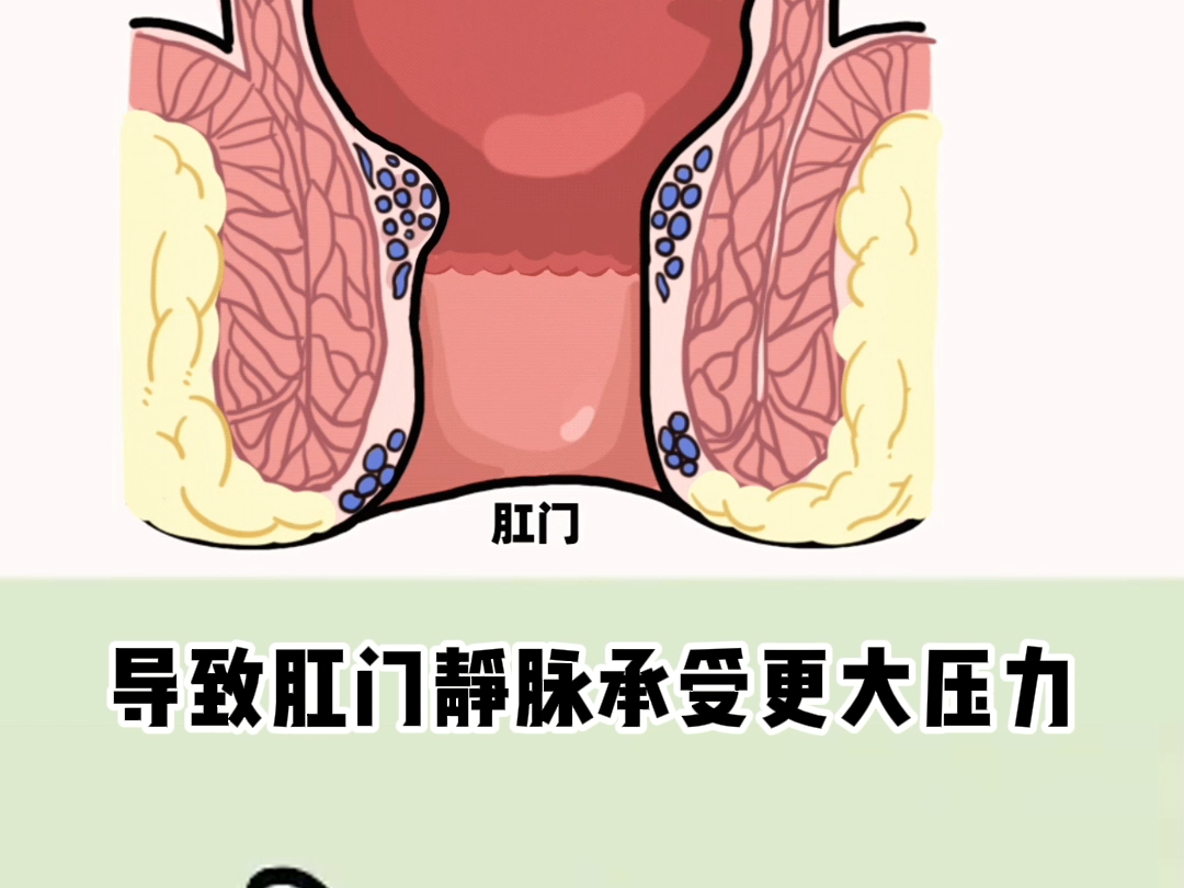 为什么会得痔疮?答案都在这哔哩哔哩bilibili