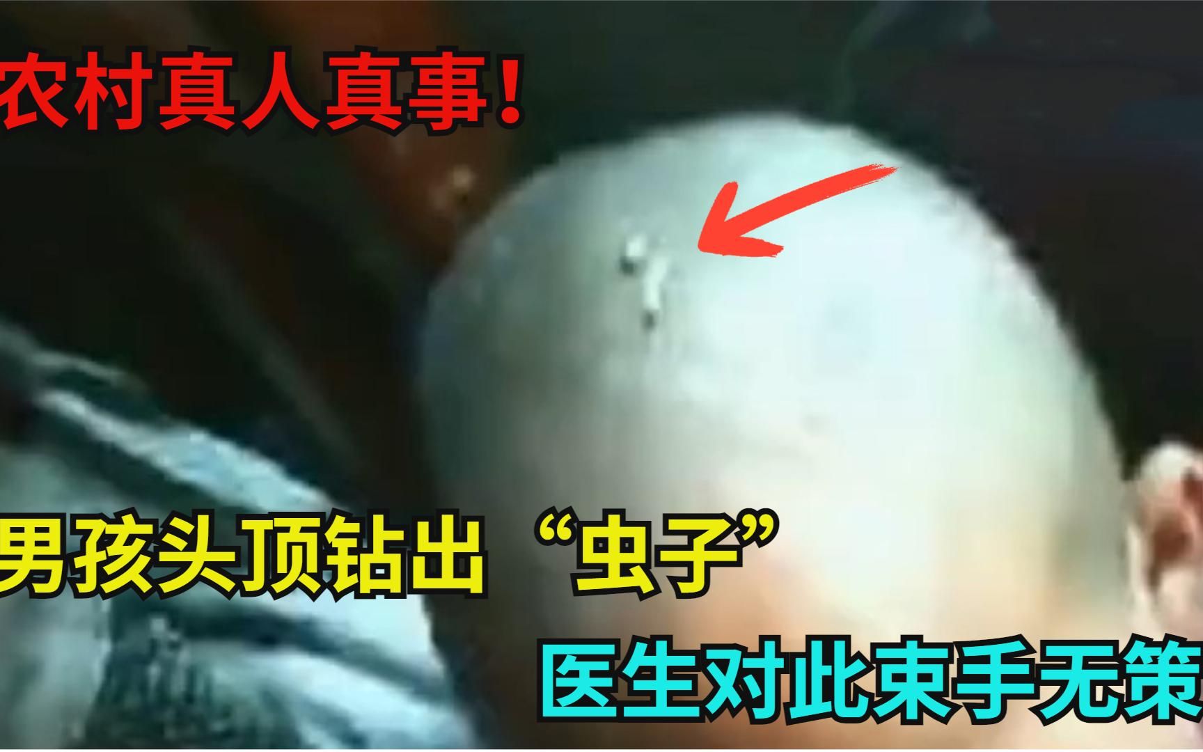 农村真人真事!13岁男孩头顶不断钻出白色"虫子",医生束手无策