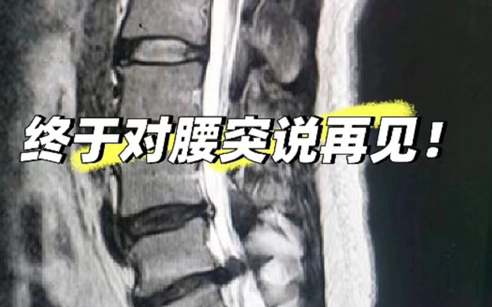 [图]腰椎间盘突出真能彻底根除？过来人分享自愈妙招！