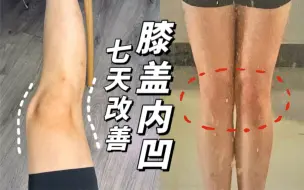 Download Video: 我的腿自己发b站了？！膝盖内凸脚踝歪必练跟练！一周见效