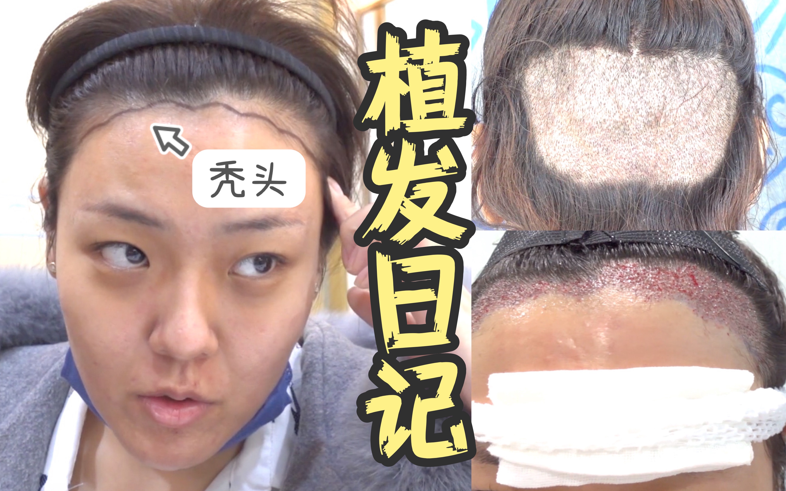 植发vlog记录(我的真实的植发经历文字)