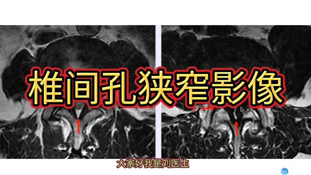 椎间孔及中央椎管狭窄MRI如何诊断?病例分享!哔哩哔哩bilibili