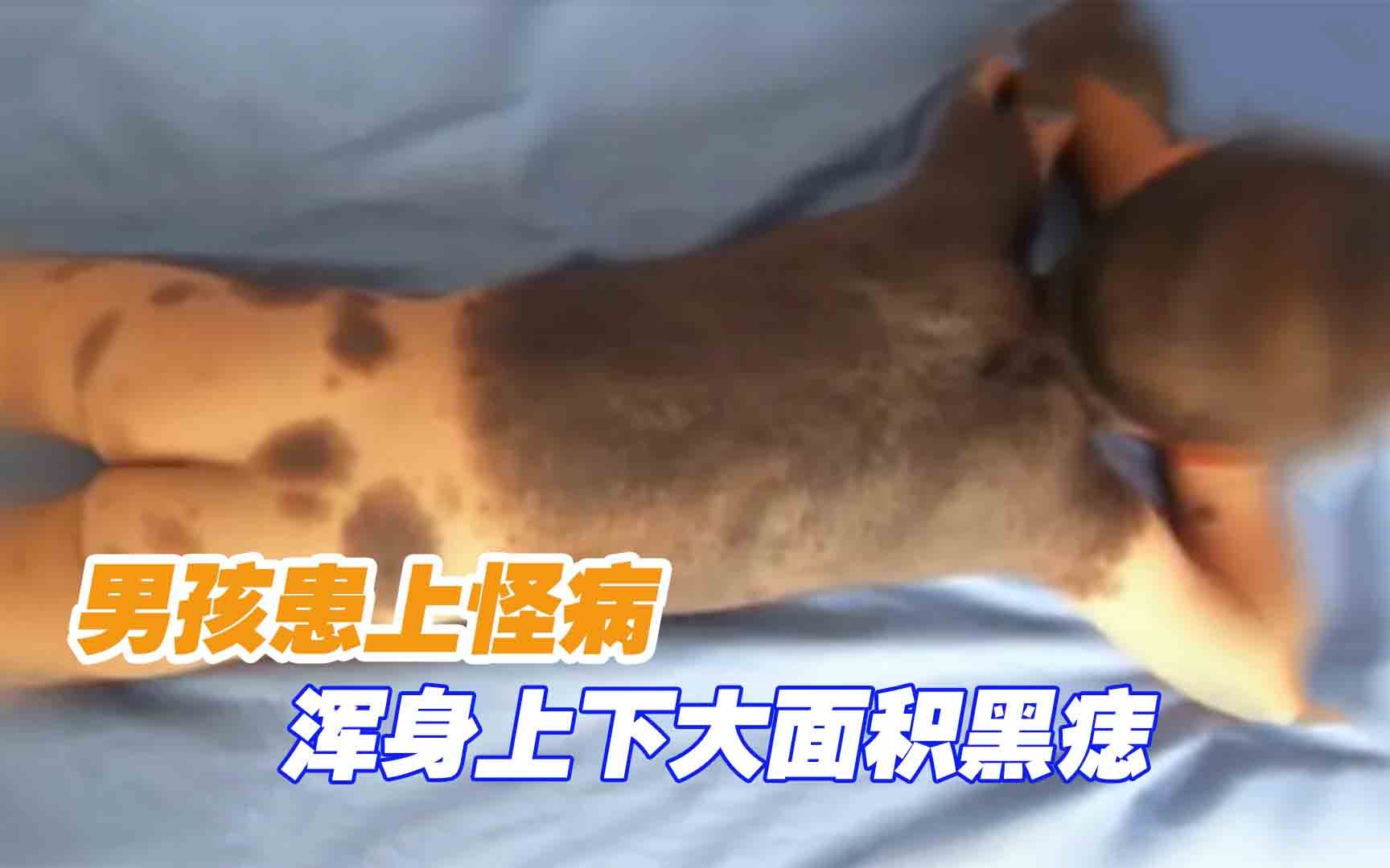 [图]男孩患上怪病，浑身上下大面积黑痣，被同学嘲笑是怪物，纪录片