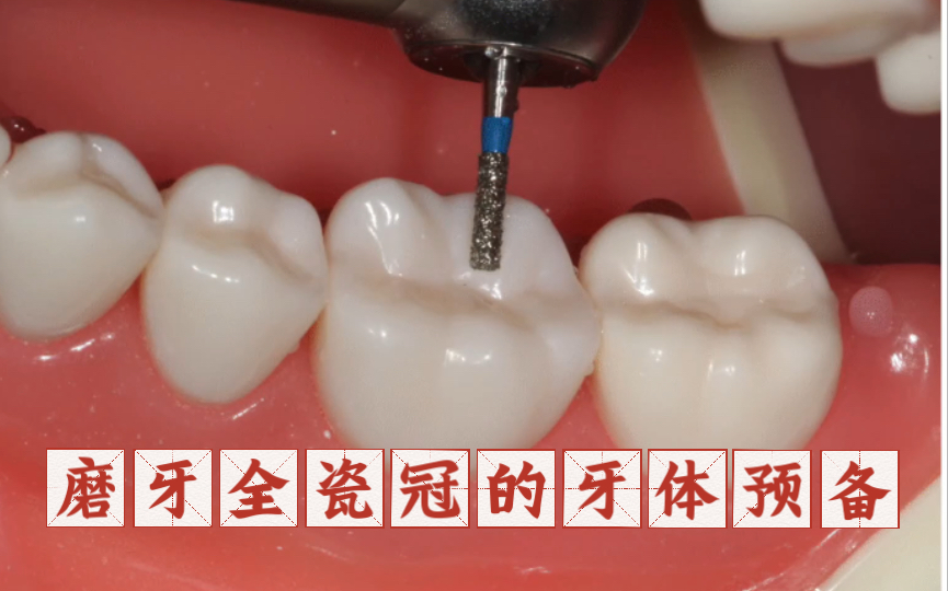 [图]下颌第一磨牙全瓷冠的牙体预备