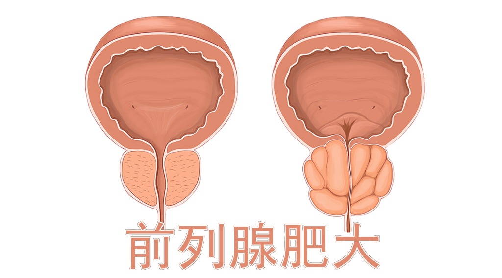 前列腺正常大小范围是多少？