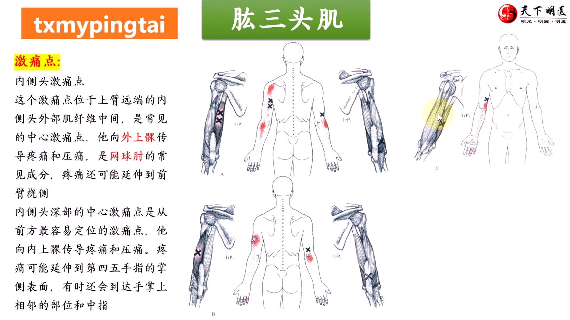 【胳膊肘痛(尺骨鹰嘴痛)】涉及肌肉详细讲解——位置,功能,激痛点
