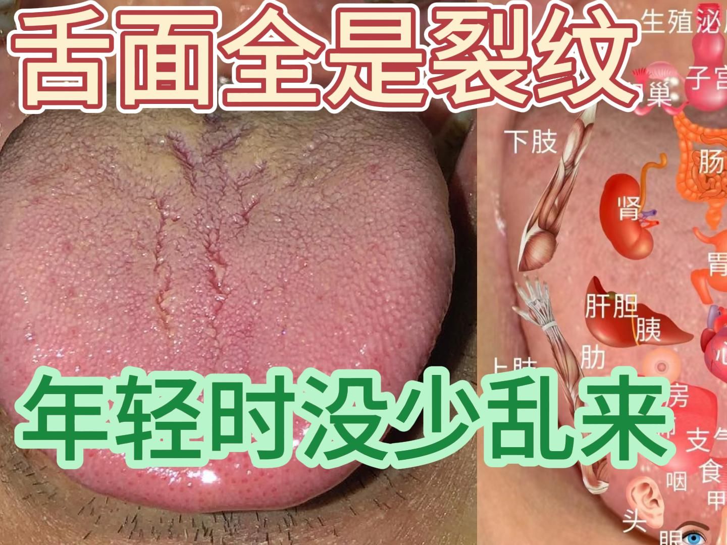 门诊舌象案例47:舌面全是裂纹,15岁就开始房事了