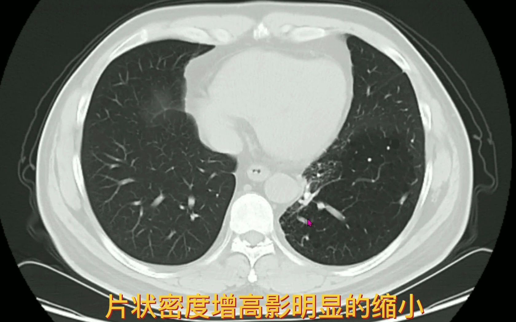 如果你在肺部的同一个位置反复感染,不妨排除一下“肺隔离症”,医生带你认识“肺隔离症CT表现”哔哩哔哩bilibili