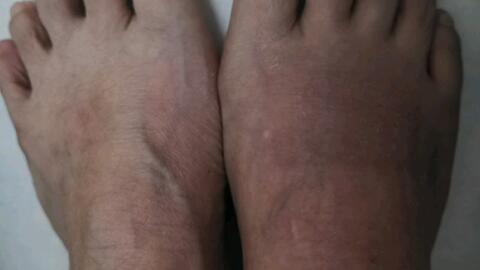 Swollen Feet and Heart Failure