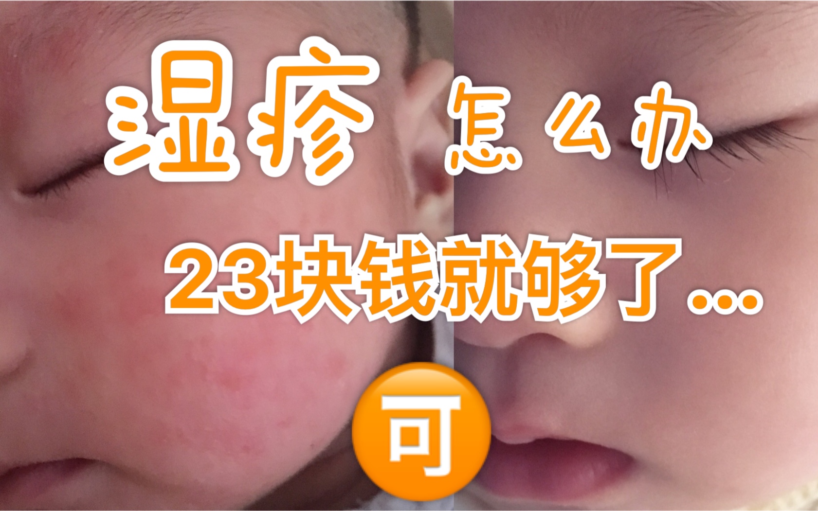 【湿疹】我用一支23块钱的药膏,轻松搞定宝宝湿疹?拒绝激素药膏!婴幼儿专用噢哔哩哔哩bilibili